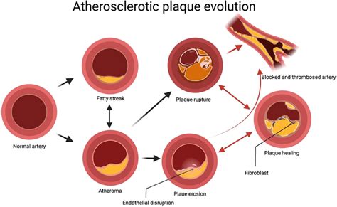 Atheroma: What It Is, Causes and Treatment .
